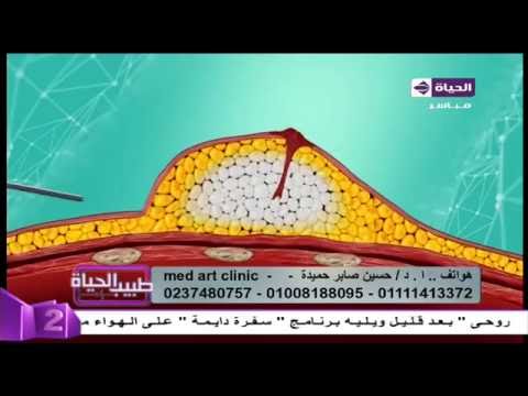 فيديو يكشف عمليات تكبير الثدي بحقن الدهون