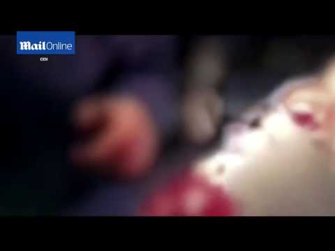 بالفيديو شاهد لحظة إزالة الأطباء قنبلة من رأس جنديبالفيديو شاهد لحظة إزالة الأطباء قنبلة من رأس جندي