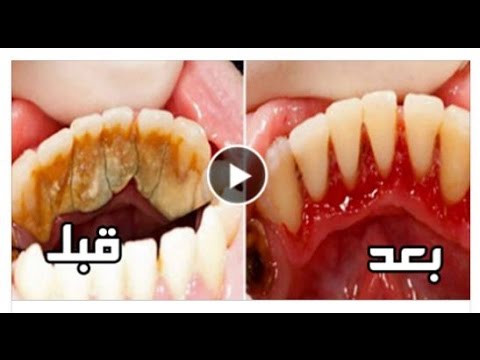 طريقة إزالة الرواسب البكتيرية من باطن أسنان الفم