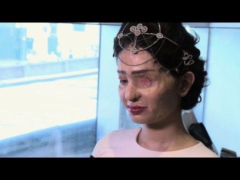 بالفيديو هندية مشوهة بالحمض الكاوي