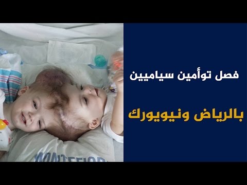 فصل توأمين سياميين في الرياض ونيويورك