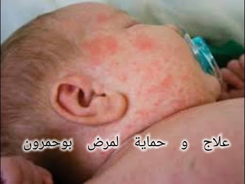 وصفة ستحمي وتعالج أطفالك من مرض بوحمرون الحصبة